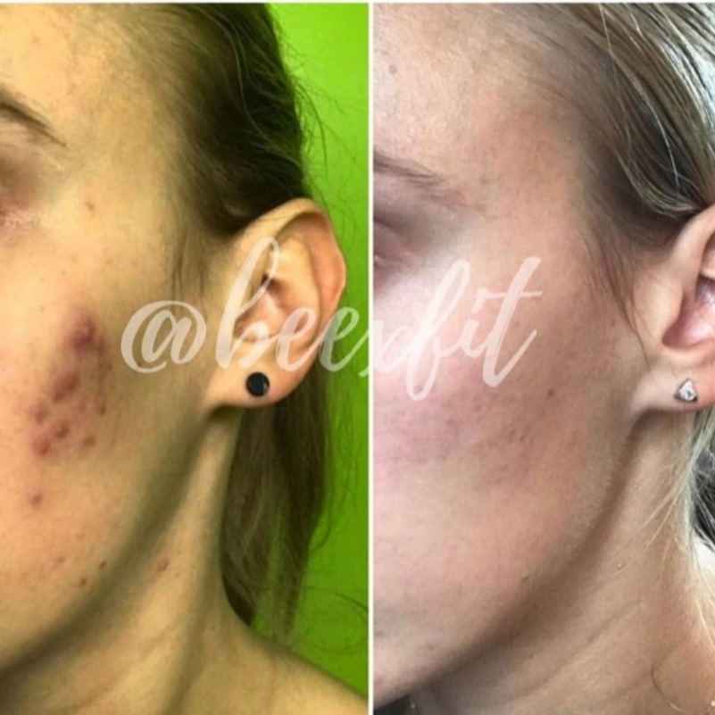 Transformation avant / après d’un membre Beexfit
